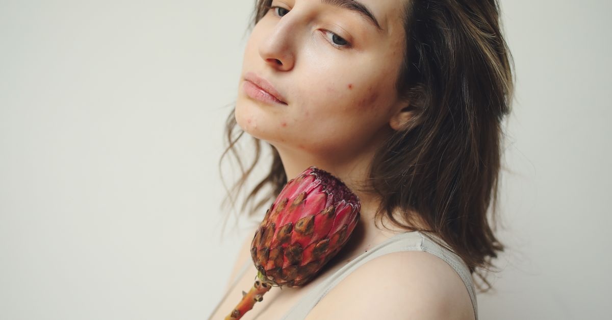 Acne e Ormoni: Cosa Succede alla Pelle e Come Ritrovare l’Equilibrio